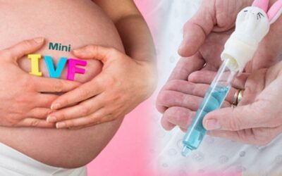 Mini-IVF:  Kích thích buồng trứng tối thiểu trong thụ tinh ống nghiệm