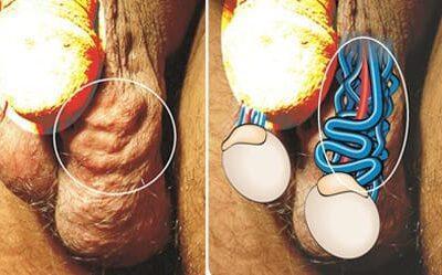 [:vi]Giãn tĩnh mạch tinh[:]