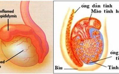 [:vi]Triệu chứng viêm tinh hoàn[:]