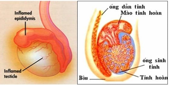 [:vi]Triệu chứng viêm tinh hoàn[:]
