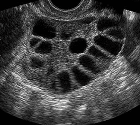 [:vi]Phương pháp hỗ trợ sinh sản đối với buồng trứng đa nang[:]