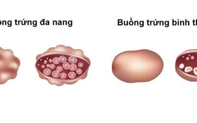 Phương pháp có con cho bệnh nhân buồng trứng đa nang