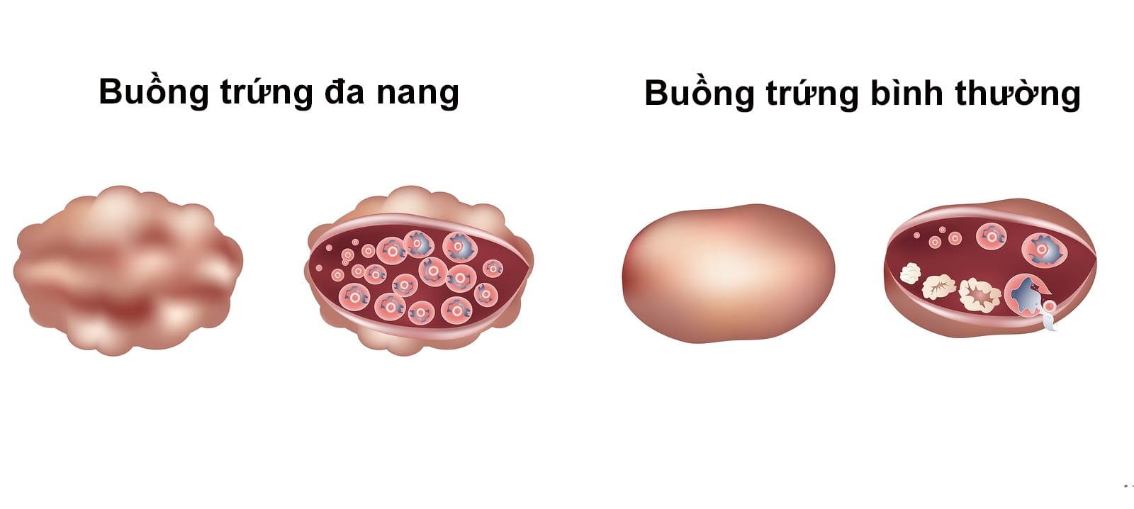 Phương pháp có con cho bệnh nhân buồng trứng đa nang