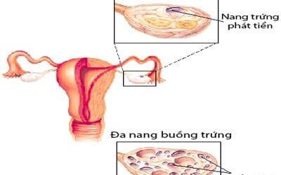 BUỒNG TRỨNG ĐA NANG