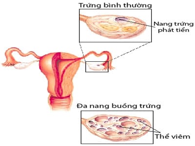 BUỒNG TRỨNG ĐA NANG