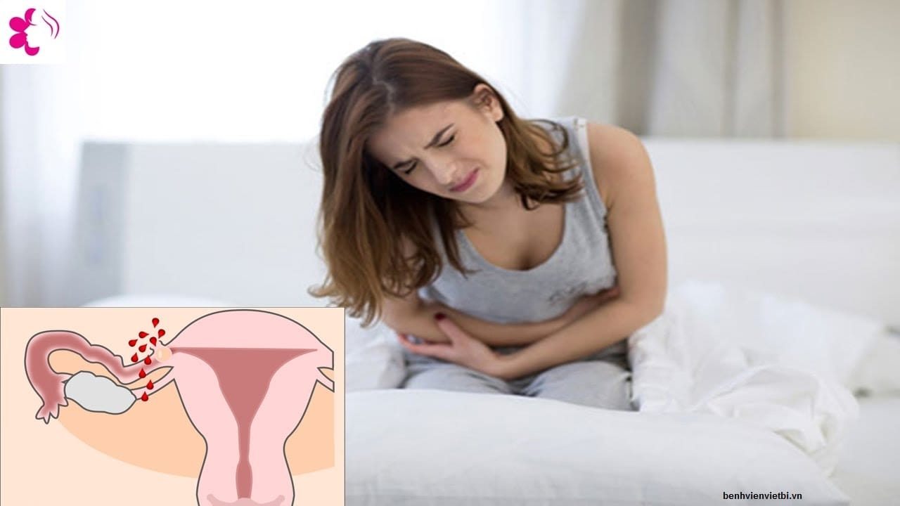Dấu hiệu đau bụng kinh trong tắc vòi trứng