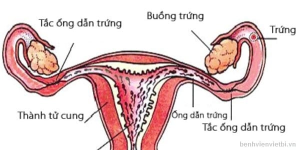 Tắc vòi trứng là một trong những nguyên nhân quan trọng gây vô sinh ở nữ giới