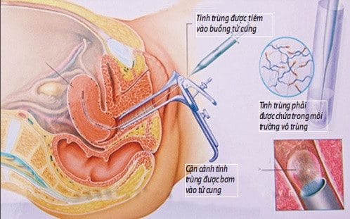 ĐIỀU TRỊ VÔ SINH BẰNG PHƯƠNG PHÁP BƠM TINH TRÙNG VÀO BUỒNG TỬ CUNG
