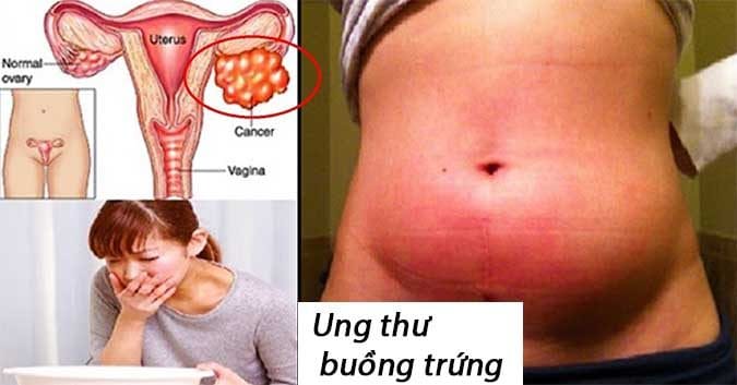 Ung thư buồng trứng