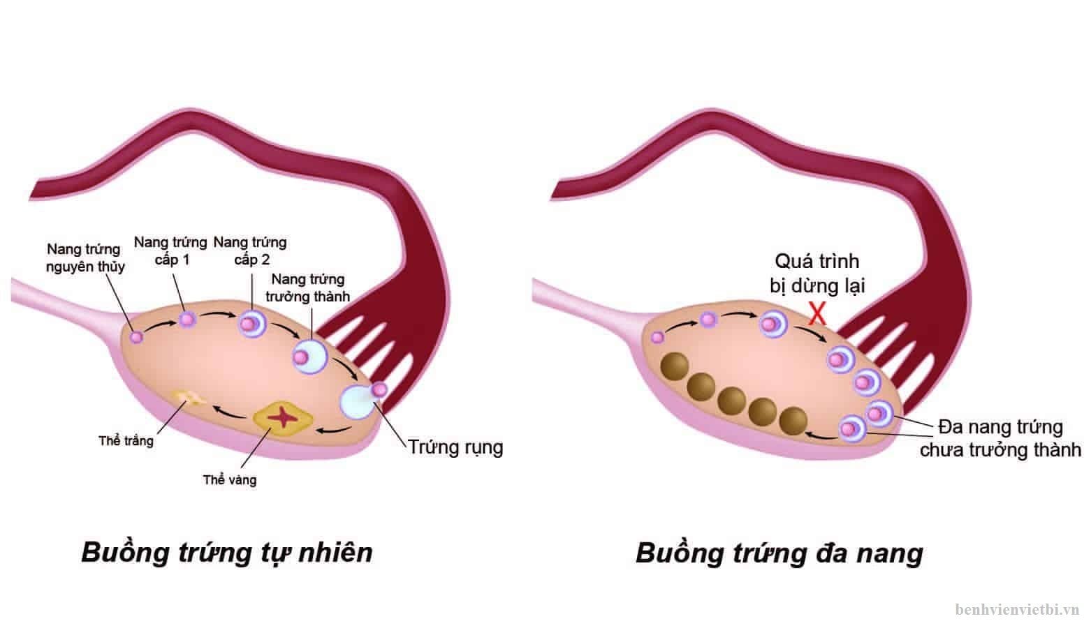 BUỒNG TRỨNG ĐA NANG – NGUYÊN NHÂN QUAN TRỌNG GÂY VÔ SINH NỮ