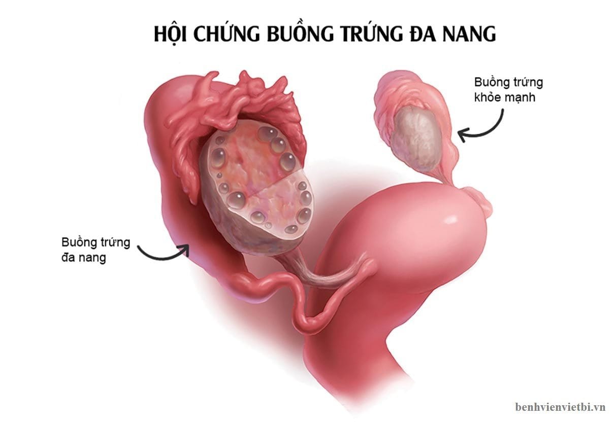 BUỒNG TRỨNG ĐA NANG: NGUYÊN NHÂN, DẤU HIỆU NHẬN BIẾT VÀ CÁCH ĐIỀU TRỊ