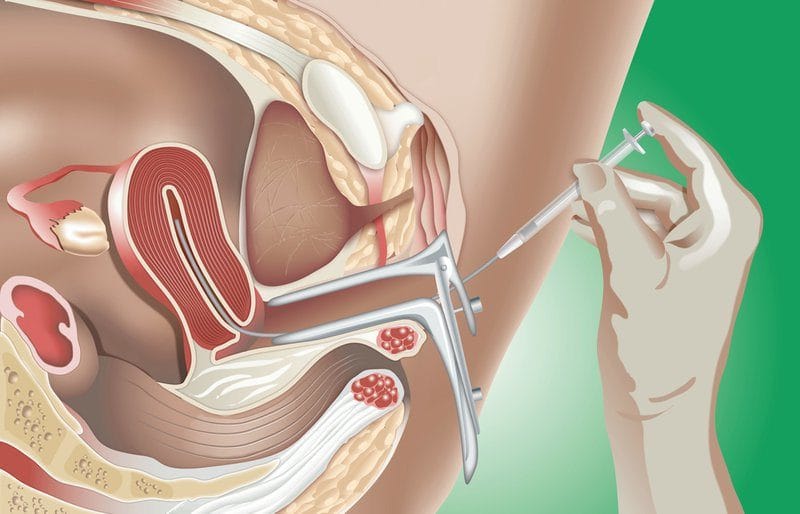 SAU KHI BƠM TINH TRÙNG CÓ NÊN QUAN HỆ TÌNH DỤC KHÔNG?