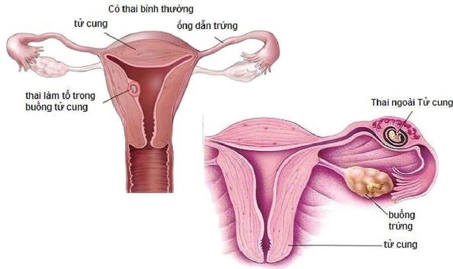 VÒI TỬ CUNG (VÒI TRỨNG) QUAN TRỌNG NHƯ THẾ NÀO TRONG THỤ THAI TỰ NHIÊN?