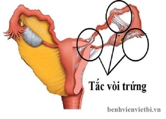 TẮC VÒI TRỨNG – NGUYÊN NHÂN DẪN ĐẾN VÔ SINH NỮ GIỚI