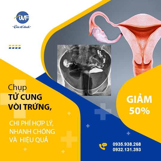 CHỤP TỬ CUNG VÒI TRỨNG – CHI PHÍ HỢP LÝ, NHANH CHÓNG VÀ  HIỆU QUẢ TẠI IVF VIỆT – BỈ
