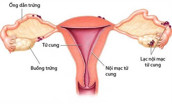 LẠC NỘI MẠC TỬ CUNG VÀ NGUY CƠ VÔ SINH Ở NỮ GIỚI