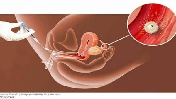 SAU KHI BƠM TINH TRÙNG CẦN KIÊNG GÌ ?