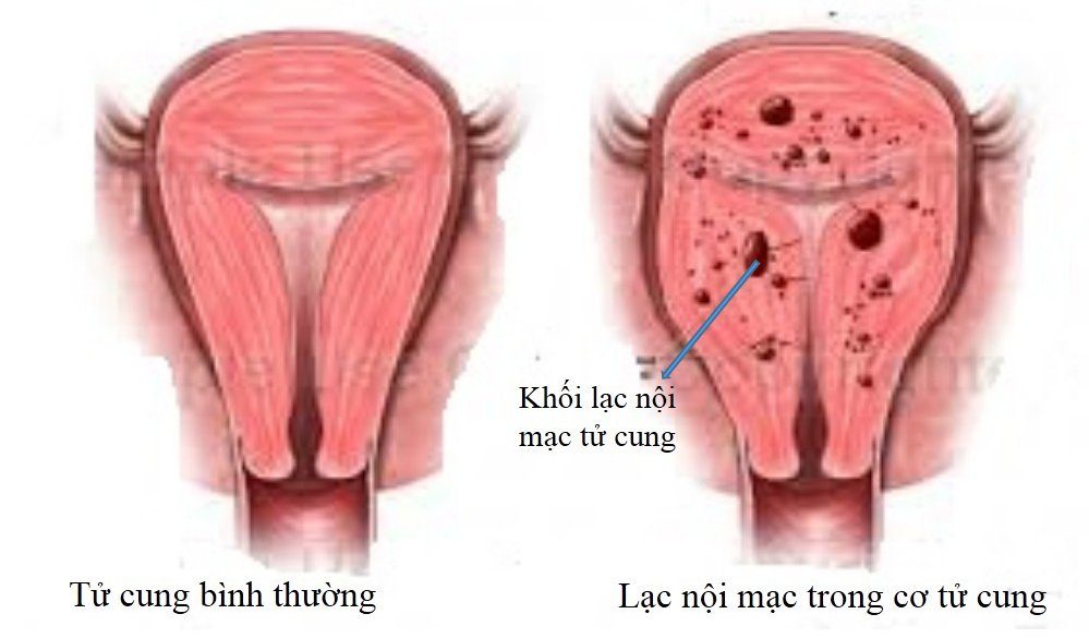LẠC NỘI MẠC TỬ CUNG ẢNH HƯỞNG ĐẾN SỨC KHỎE SINH SẢN NHƯ THẾ NÀO?