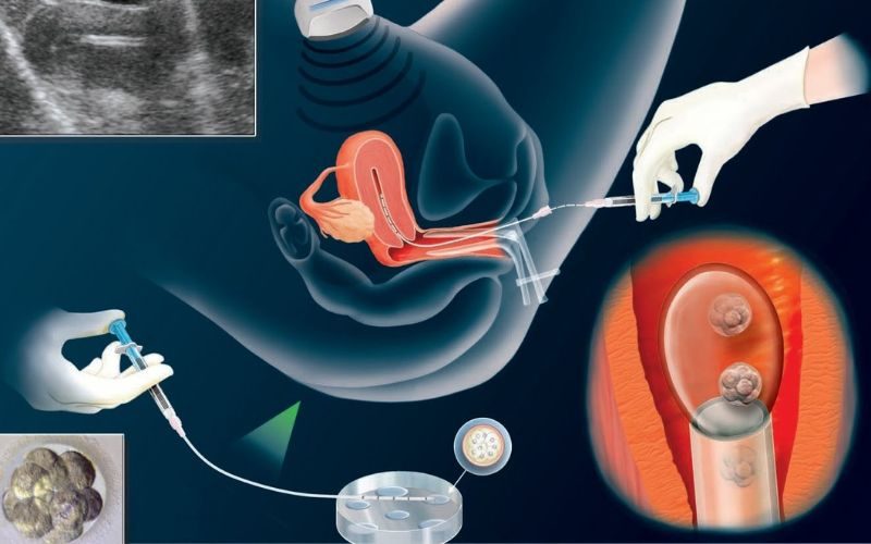 Thụ tinh nhân tạo bơm IUI: Tỷ lệ thụ thai và quy trình tiến hành