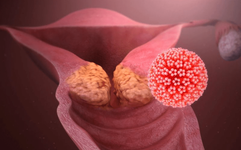  Nguyên nhân chủ yếu là từ virus HPV  