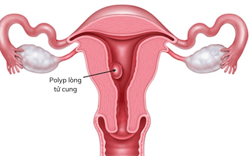 Polyp lòng tử cung có tự hết không?