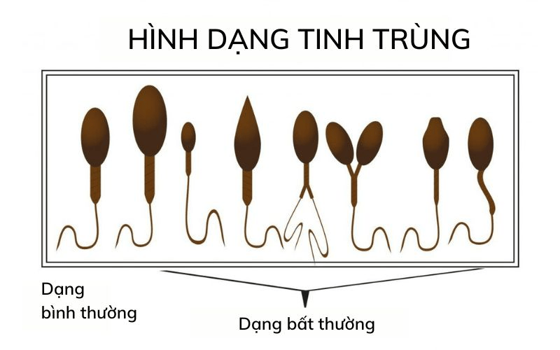 Hình dạng tinh trùng bất thường và nguyên nhân