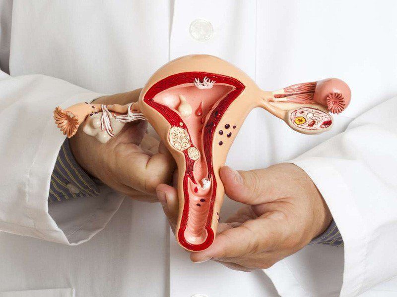 POLYP LÒNG TỬ CUNG NGUY HIỂM THẾ NÀO ĐẾN KHẢ NĂNG SINH SẢN CỦA NỮ GIỚI