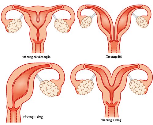 BẤT THƯỜNG Ở TỬ CUNG ẢNH HƯỞNG ĐẾN KHẢ NĂNG SINH SẢN NHƯ THẾ NÀO?