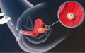 Top 5 phương pháp hỗ trợ sinh sản phổ biến và tỷ lệ “đậu thai” cao