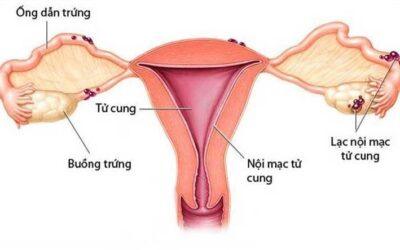 LẠC NỘI MẠC TỬ CUNG VÀ NGUY CƠ VÔ SINH Ở NỮ GIỚI