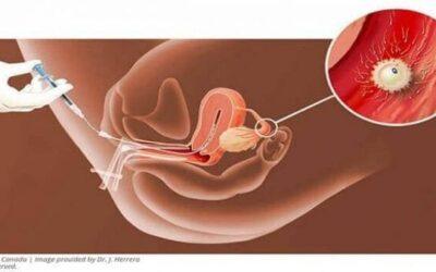 SAU KHI BƠM TINH TRÙNG CẦN KIÊNG GÌ ?