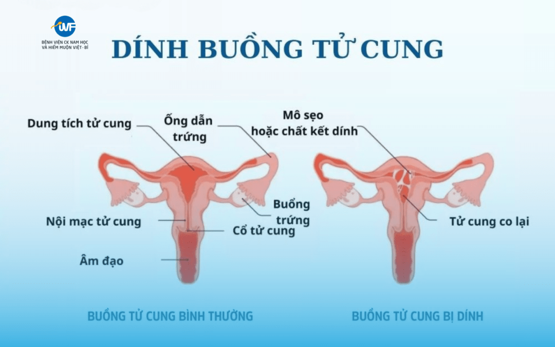 DÍNH BUỒNG TỬ CUNG: NGUYÊN NHÂN GÂY VÔ SINH NỮ
