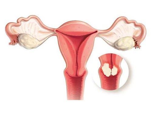 DÍNH BUỒNG TỬ CUNG: NGUYÊN NHÂN GÂY VÔ SINH NỮ