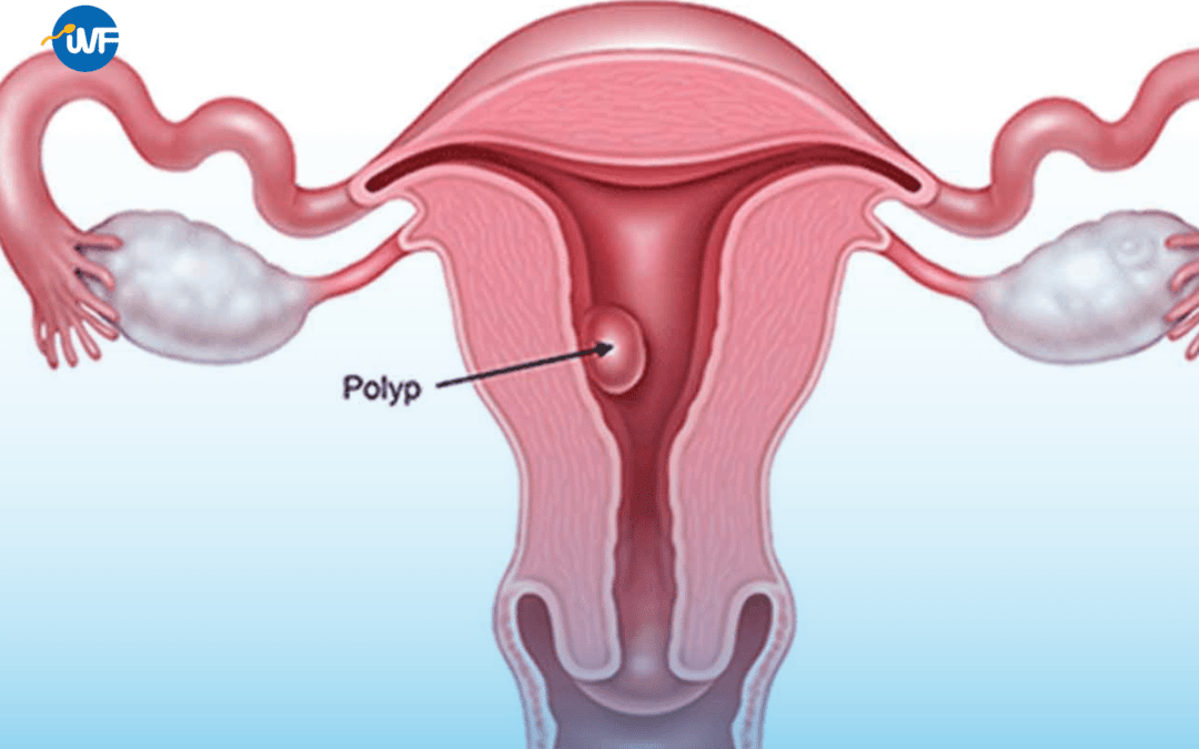 Polyp Tử Cung: Nguyên Nhân, Dấu Hiệu, Chẩn Đoán và Cách Xử Lý