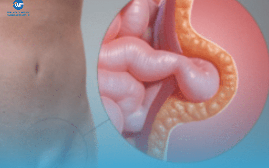 Tinh hoàn ẩn ở trẻ: Dấu hiệu, Nguy cơ vô sinh & Thời điểm “vàng” để phẫu thuật