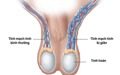 Giãn tĩnh mạch thừng tinh: Nguyên nhân, triệu chứng, điều trị