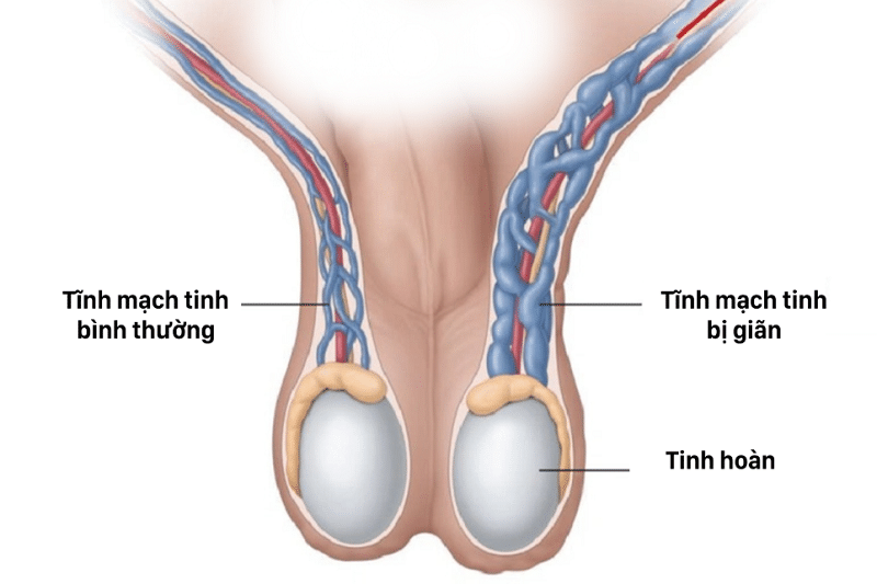 Giãn tĩnh mạch thừng tinh: Nguyên nhân, triệu chứng, điều trị