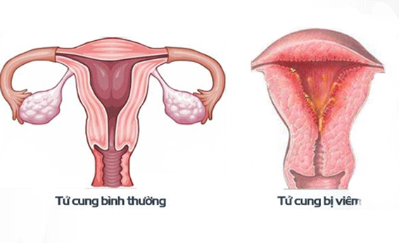viêm tử cung mãn tính
