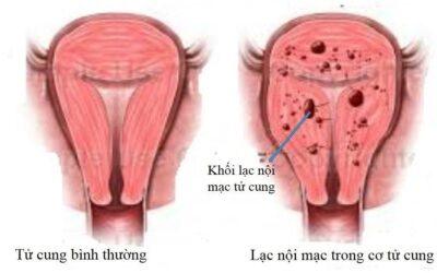 Lạc nội mạc tử cung có gây ảnh hưởng đến chức năng làm mẹ không?