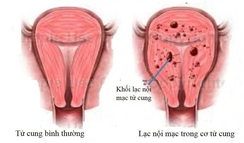 Lạc nội mạc tử cung có gây ảnh hưởng đến chức năng làm mẹ không?